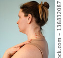 Woman having pimples, red spots on her chest. Dermatoses, skin condition problems, dermatological problem during puberty. 138832087