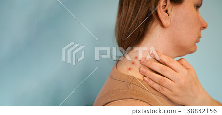 painful of inflamed damage acne on neck painful of inflamed damage acne on neck 138832156