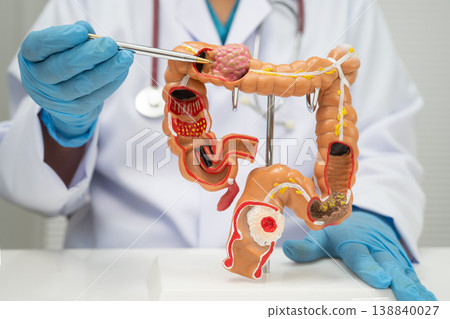 Colorectal cancer, doctor holding intestine colon human model. Colorectal cancer, doctor holding intestine colon human model. 138840027