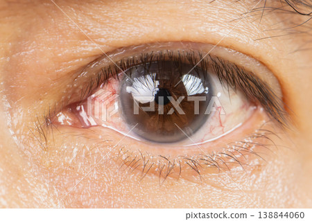 Blunt Eye Trauma , An eye impact injury causing potential damage to the eyeball. Blunt Eye Trauma , An eye impact injury causing potential damage to the eyeball. 138844060