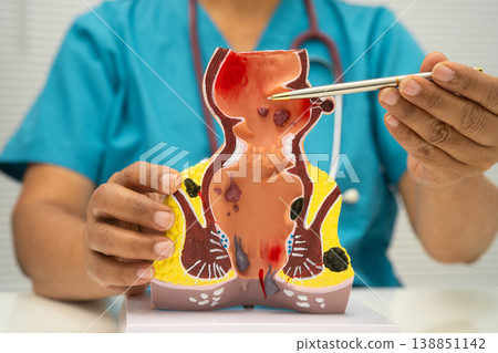 Asian doctor with rectum and hemorrhoid human model, inflamed vascular structure. 138851142