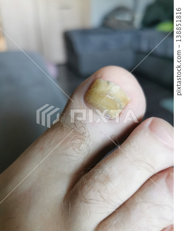 mold on the nail 138851816