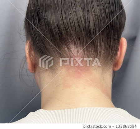 atopic dermatitis in an adult young girl has red scaly spots on the back of the neck close-up atopic dermatitis in an adult young girl has red scaly spots on the back of the neck close-up 138868584