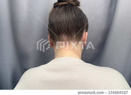 atopic dermatitis in an adult young girl has red scaly spots on the back of the neck close-up atopic dermatitis in an adult young girl has red scaly spots on the back of the neck close-up 138868587