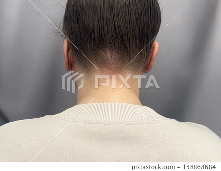 atopic dermatitis in an adult young girl has red scaly spots on the back of the neck close-up atopic dermatitis in an adult young girl has red scaly spots on the back of the neck close-up 138868684