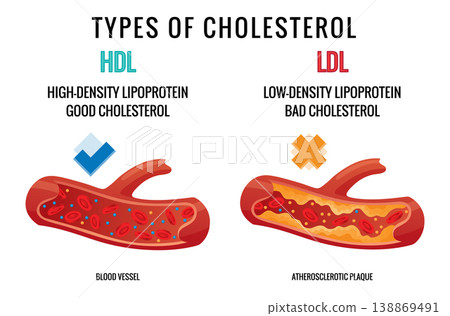 Types of cholesterol in human blood vessels. Normal and narrowed artery for explanation diseases. High-Density Lipoprotein HDL and Low-Density Lipoprotein LDL. Vector illustration 138869491