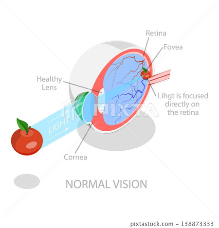 3D Isometric Flat Vector Illustration of Vision Disorder, Far-Sightedness And Near-Sightedness Anatomical Diagram. Item 3 3D Isometric Flat Vector Illustration of Vision Disorder, Far-Sightedness And Near-Sightedness Anatomical Diagram. Item 3 138873333