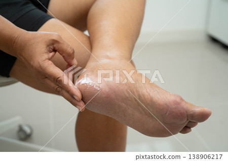 Asian woman check feet with crack and dry heel skin, Diabetic Foot. Asian woman check feet with crack and dry heel skin, Diabetic Foot. 138906217