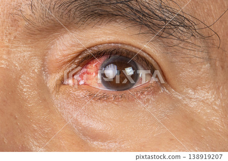 Blunt Eye Trauma , An eye impact injury causing potential damage to the eyeball. Blunt Eye Trauma , An eye impact injury causing potential damage to the eyeball. 138919207