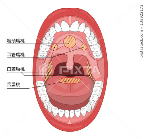 An illustration that clearly shows the inside of an adult's mouth when it is wide open, and the tonsils inside the mouth. 138922172