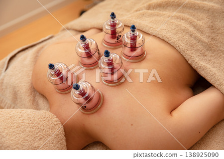 美容院使用吸杯（拔罐）進行治療的照片。 138925090