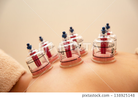 A photo taken during a beauty treatment using suction cups (cupping). A photo taken during a beauty treatment using suction cups (cupping). 138925148
