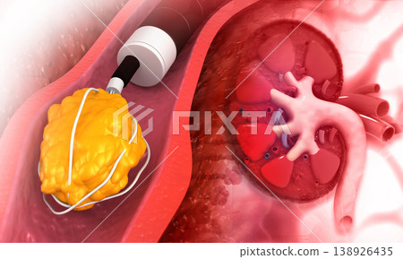kidney stone removal concept background kidney stone removal concept background 138926435