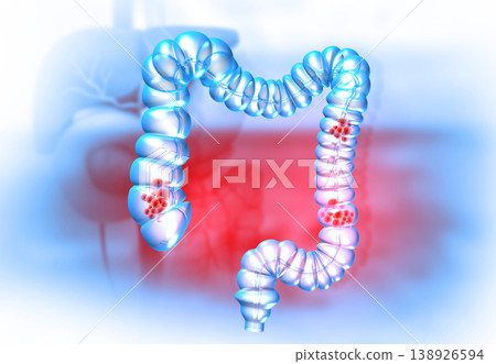 Colon cancer concept on medical background 138926594