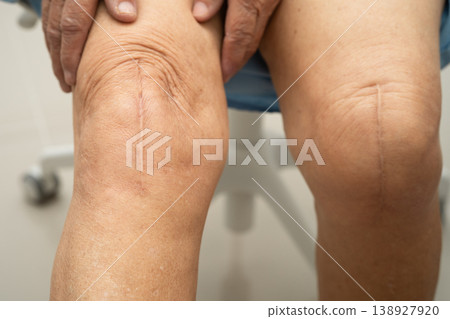 Asian elderly woman patient with scar knee replacement surgery in hospital. Asian elderly woman patient with scar knee replacement surgery in hospital. 138927920