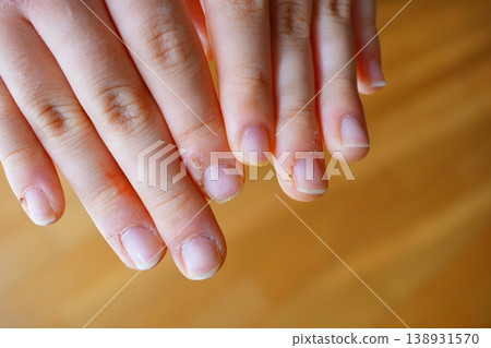 Image of hangnails and dry fingertips in children 138931570