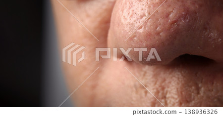 Blackheads acne. Macro close up image of facial skin and nose. showing visible pores blackheads acne marks and skin texture. Ideal for skincare dermatology cosmetic treatment and skin health concept 138936326
