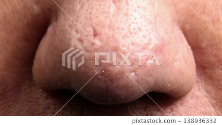 Blackheads acne. Macro close up image of facial skin and nose. showing visible pores blackheads acne marks and skin texture. Ideal for skincare dermatology cosmetic treatment and skin health concept 138936332