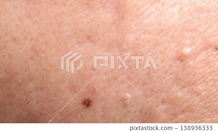 Blackheads acne. Macro close up image of facial skin and nose. showing visible pores blackheads acne marks and skin texture. Ideal for skincare dermatology cosmetic treatment and skin health concept Blackheads acne. Macro close up image of facial skin and nose. showing visible pores blackheads acne marks and skin texture. Ideal for skincare dermatology cosmetic treatment and skin health concept 138936333