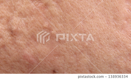 Blackheads acne. Macro close up image of facial skin and nose. showing visible pores blackheads acne marks and skin texture. Ideal for skincare dermatology cosmetic treatment and skin health concept Blackheads acne. Macro close up image of facial skin and nose. showing visible pores blackheads acne marks and skin texture. Ideal for skincare dermatology cosmetic treatment and skin health concept 138936334