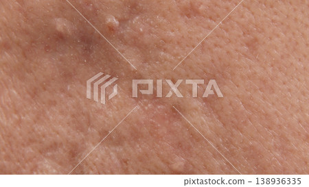 Blackheads acne. Macro close up image of facial skin and nose. showing visible pores blackheads acne marks and skin texture. Ideal for skincare dermatology cosmetic treatment and skin health concept 138936335