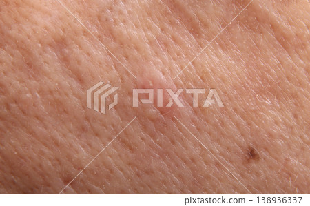 Blackheads acne. Macro close up image of facial skin and nose. showing visible pores blackheads acne marks and skin texture. Ideal for skincare dermatology cosmetic treatment and skin health concept Blackheads acne. Macro close up image of facial skin and nose. showing visible pores blackheads acne marks and skin texture. Ideal for skincare dermatology cosmetic treatment and skin health concept 138936337