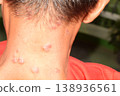 Dermatology, allergy, itching, red spot or rash on skin, health care and medical concept. 138936561