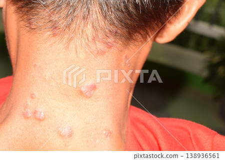 Dermatology, allergy, itching, red spot or rash on skin, health care and medical concept. Dermatology, allergy, itching, red spot or rash on skin, health care and medical concept. 138936561