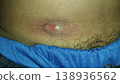 slow growing lump or cyst that develops in the abdomen 138936562