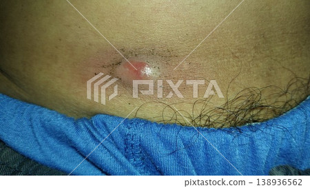 slow growing lump or cyst that develops in the abdomen slow growing lump or cyst that develops in the abdomen 138936562