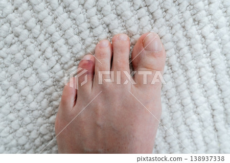 Close-up of bare foot showing injured toe with signs of bruising. Medical condition concept, pain and trauma detail. 138937338