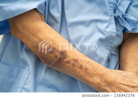 Ecchymosis, elderly bleeding on her arm after taking aspirin. Ecchymosis, elderly bleeding on her arm after taking aspirin. 138942376