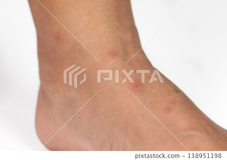 Close up view of flea bites on lower legs and feet skin. 138951198