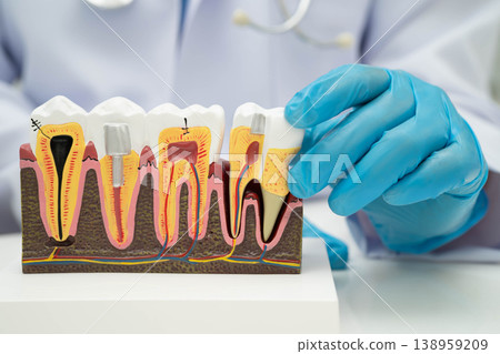 Dentist holding dental implant, artificial tooth roots into jaw, root canal of dental treatment, gum disease, teeth model for dentist. Dentist holding dental implant, artificial tooth roots into jaw, root canal of dental treatment, gum disease, teeth model for dentist. 138959209