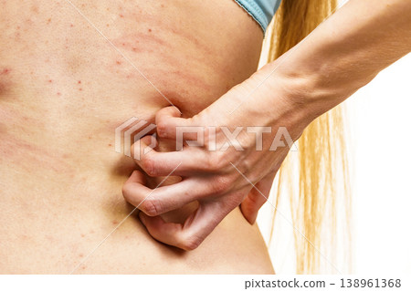 Woman scratching her itchy back with allergy rash Woman scratching her itchy back with allergy rash 138961368
