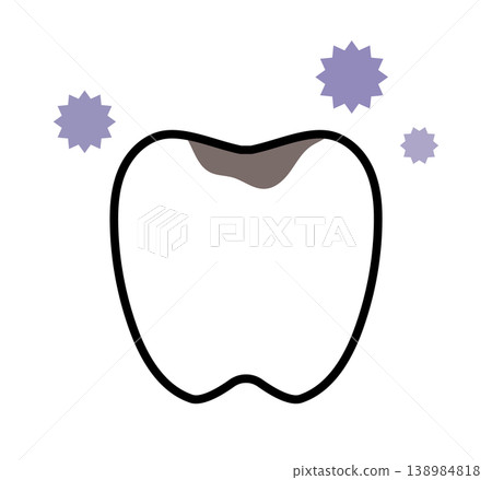 Illustration of a tooth with a cavity, stains, and pain. Illustration of a tooth with a cavity, stains, and pain. 138984818