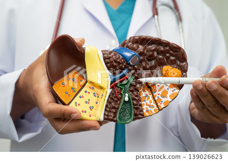 Cirrhosis, Liver cancer, fatty liver, Asian woman with liver human anatomy model. Cirrhosis, Liver cancer, fatty liver, Asian woman with liver human anatomy model. 139026623
