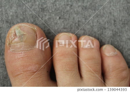 Damaged toenail plate close-up. Nail and skin diseases fungus 139044393