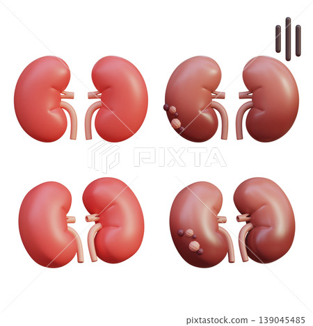 Healthy Kidney and Sick Kidney 3D Illustration Healthy Kidney and Sick Kidney 3D Illustration 139045485