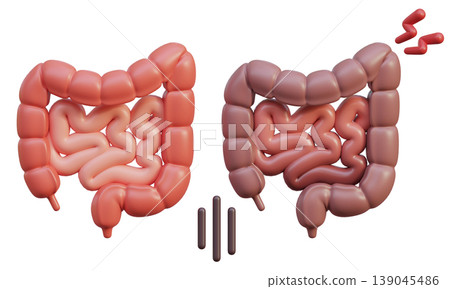 Healthy Intestine and Sick Intestine 3D Illustration 139045486