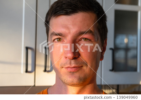 Swollen eyelid, face after sting (bee, wasp, insect), allergy and local inflammation, risk of cellulitis, foreign object, eye injury, pain, urgent care needed. 139049960