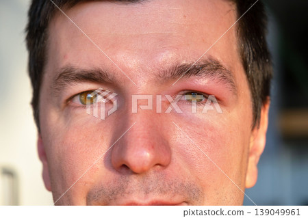 Swollen, red eye from bee sting, severe eyelid edema, allergic inflammation, risk of infection, immediate treatment required, trauma or conjunctivitis possible. 139049961