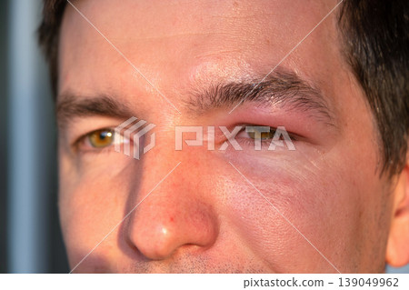 Upper eyelid swelling, allergy to bee sting, risk of anaphylaxis, pain, redness, local infection, possible causes: injury, conjunctivitis, abscess, urgent therapy. 139049962