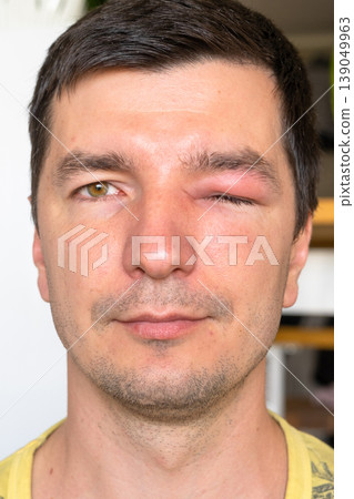 Eye edema after bee sting, severe puffiness and redness, allergic inflammation, risk of infection, cellutitis, conjunctivitis, foreign object, medical help advised. Eye edema after bee sting, severe puffiness and redness, allergic inflammation, risk of infection, cellutitis, conjunctivitis, foreign object, medical help advised. 139049963