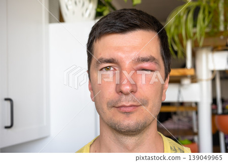 Puffy eye from bee sting, allergy, local swelling, redness, risk of infection or conjunctivitis, need urgent treatment, possible complications for eyesight. Puffy eye from bee sting, allergy, local swelling, redness, risk of infection or conjunctivitis, need urgent treatment, possible complications for eyesight. 139049965