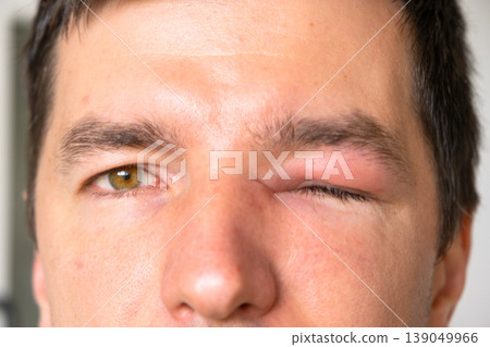 Unilateral eyelid swelling after bee sting, allergic reaction, pain, redness, risk factors: infection, injury, foreign body, conjunctivitis, abscess, urgent care. Unilateral eyelid swelling after bee sting, allergic reaction, pain, redness, risk factors: infection, injury, foreign body, conjunctivitis, abscess, urgent care. 139049966