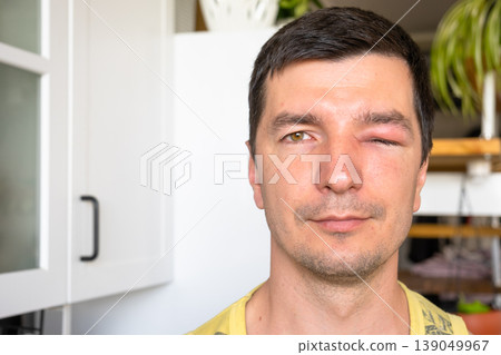 Post-treatment recovery after bee sting to eyelid, swelling reduced, allergy history, medical care, possible causes for edema: trauma, infection, conjunctivitis. Post-treatment recovery after bee sting to eyelid, swelling reduced, allergy history, medical care, possible causes for edema: trauma, infection, conjunctivitis. 139049967