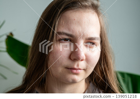 Teenager girl with acne skin. High quality photo Teenager girl with acne skin. High quality photo 139051218