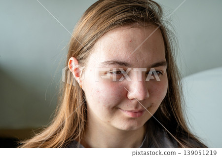 Teenager girl with acne skin. High quality photo Teenager girl with acne skin. High quality photo 139051219