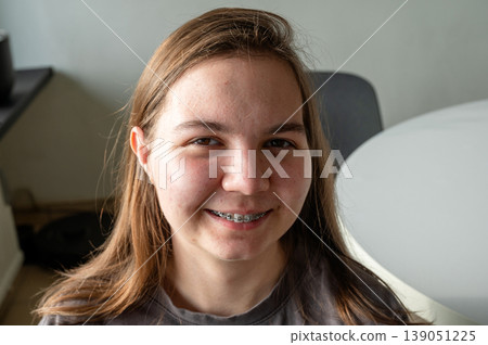 Teenager girl with acne skin. High quality photo Teenager girl with acne skin. High quality photo 139051225